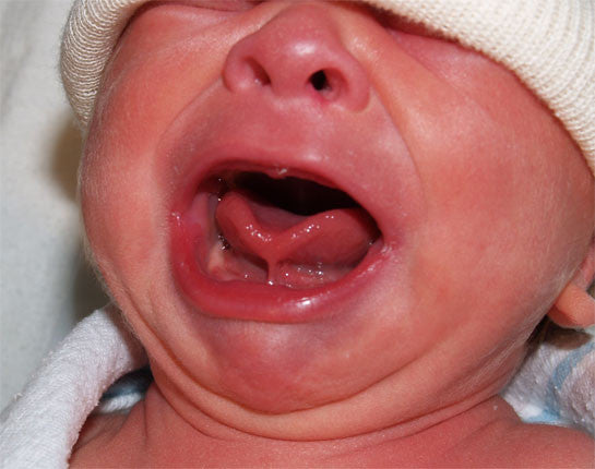 Could Could Tongue Tie Be The Cause Of Your Baby's Unhappiness? Jessica's  Story – Babocush Limited