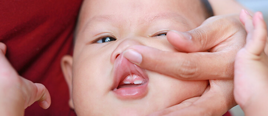 What Is Lip Tie & What To Do If Your Baby Has It?
