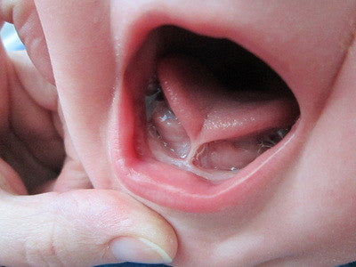 Tongue tie in babies: What you need to know by Babocush.com